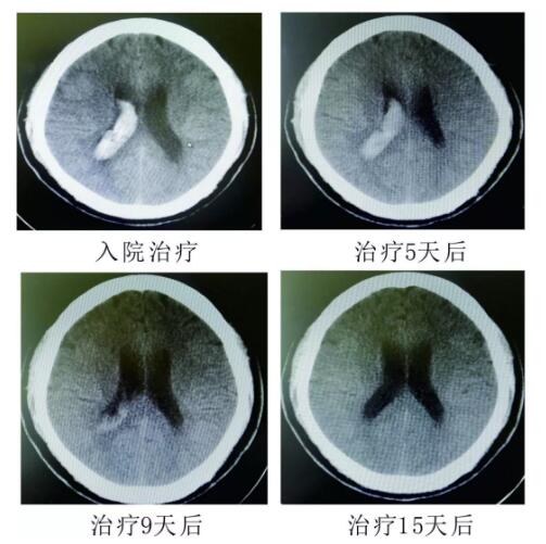 腦出血你不得不引起重視的疾病?。?！