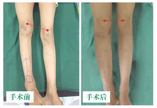 女孩墜梯右腿縮短5cm，幸得醫(yī)生及時診治恢復(fù)正常腿型