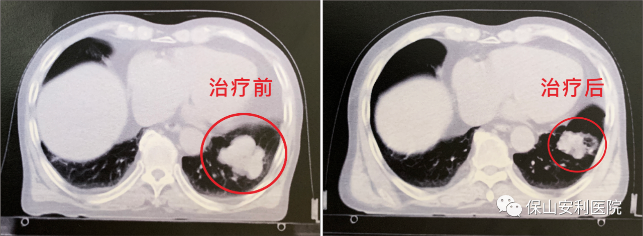 不做手術(shù)，早期肺癌也能根治！